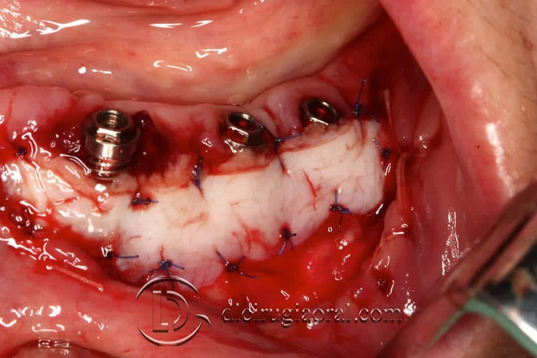Injerto libre epitelial en pacientes con periimplantitis