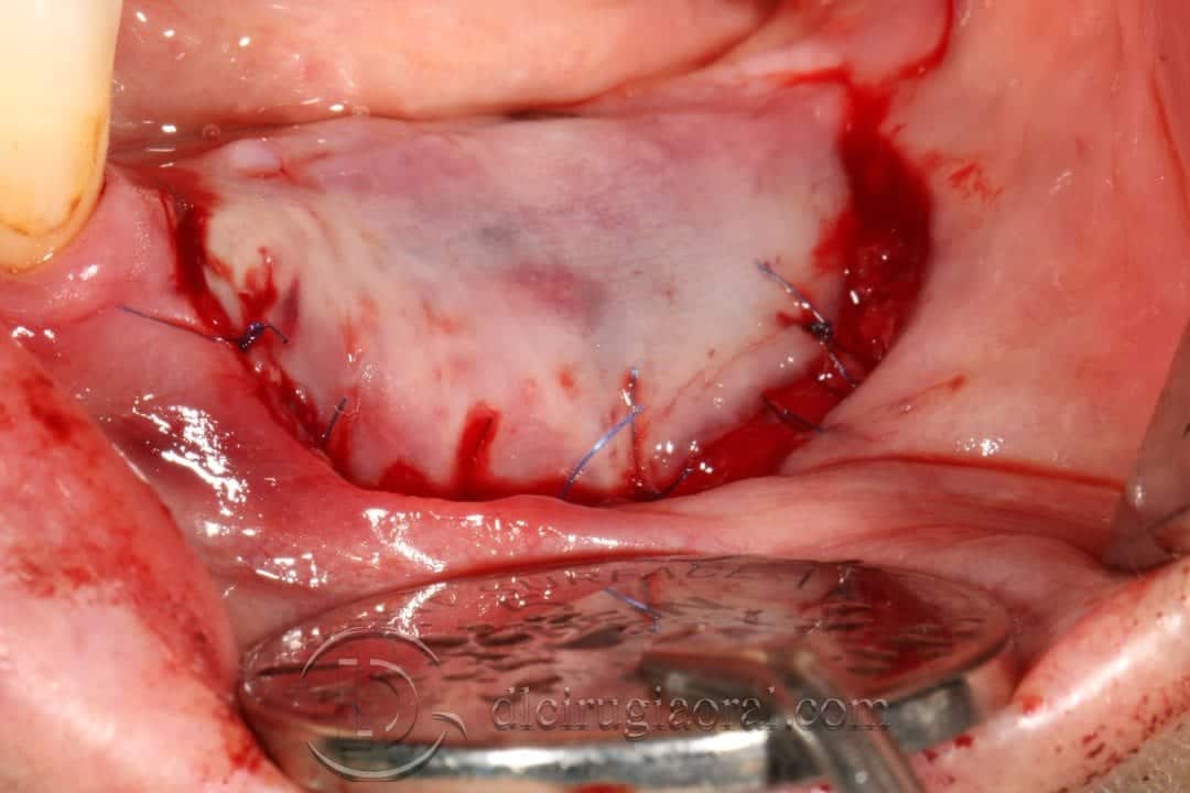Vestibuloplastia de Kazanjian + Implante en una sola cirugía