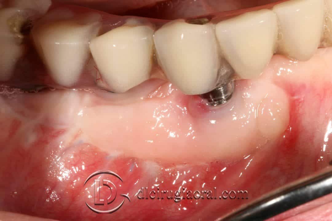 Injerto libre epitelial en pacientes con periimplantitis