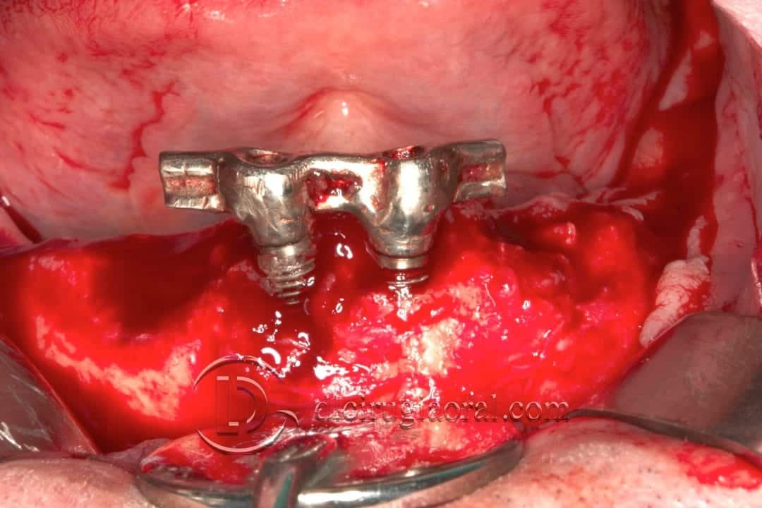 implantes dentales en sobredentadura inferior