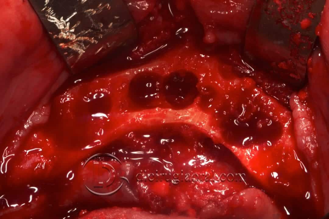 implantes dentales en sobredentadura inferior