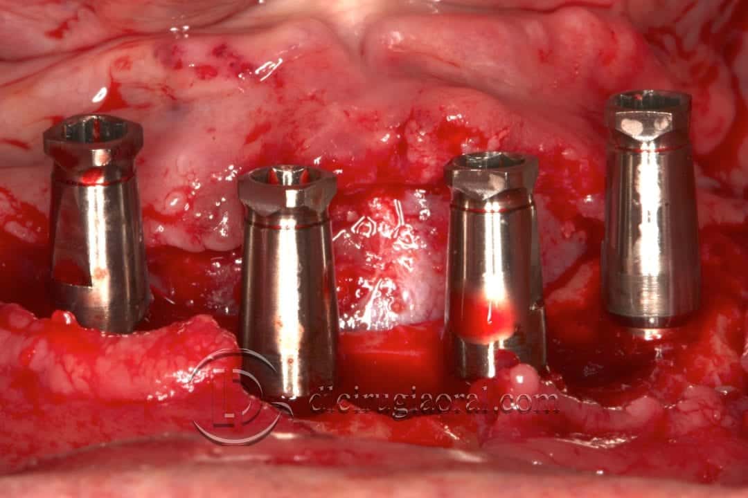 implantes dentales en sobredentadura inferior