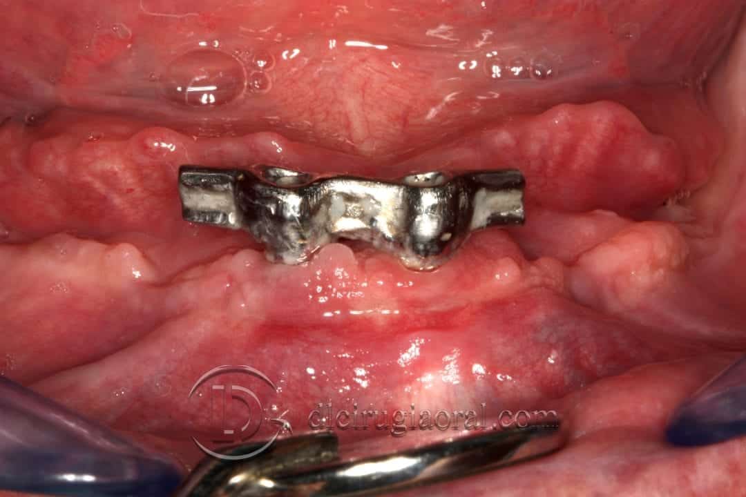 implantes dentales en sobredentadura inferior