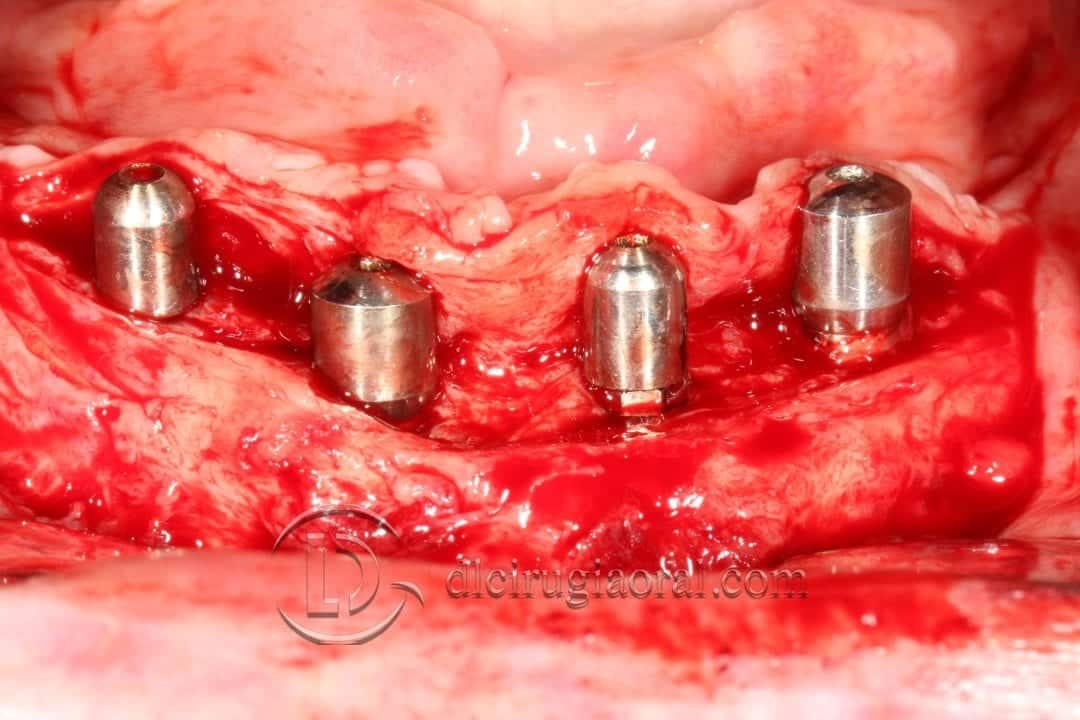 implantes dentales en sobredentadura inferior