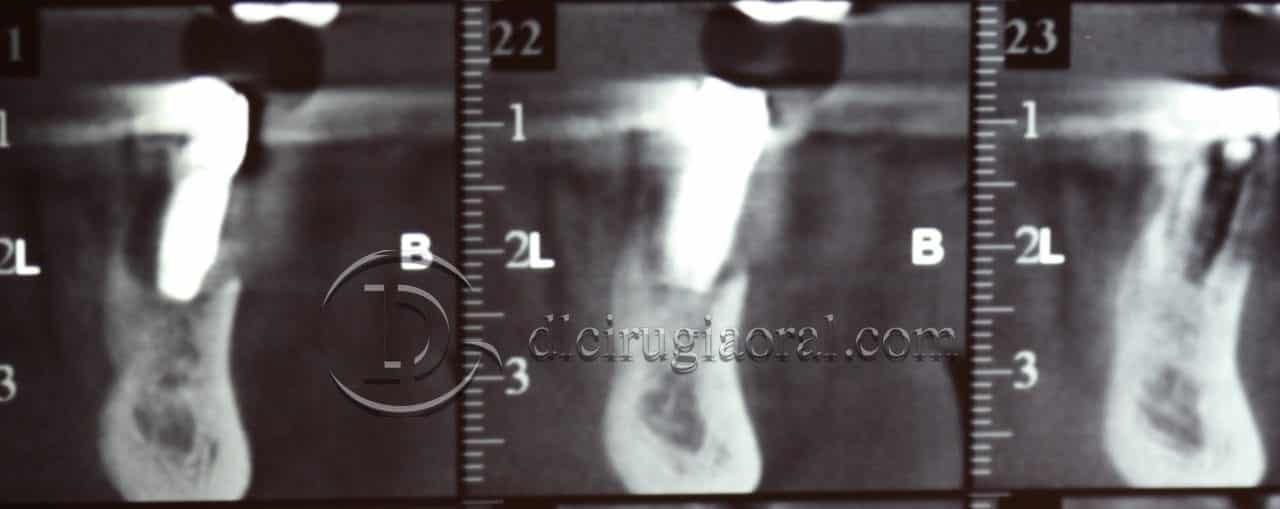 implantes dentales en sobredentadura inferior