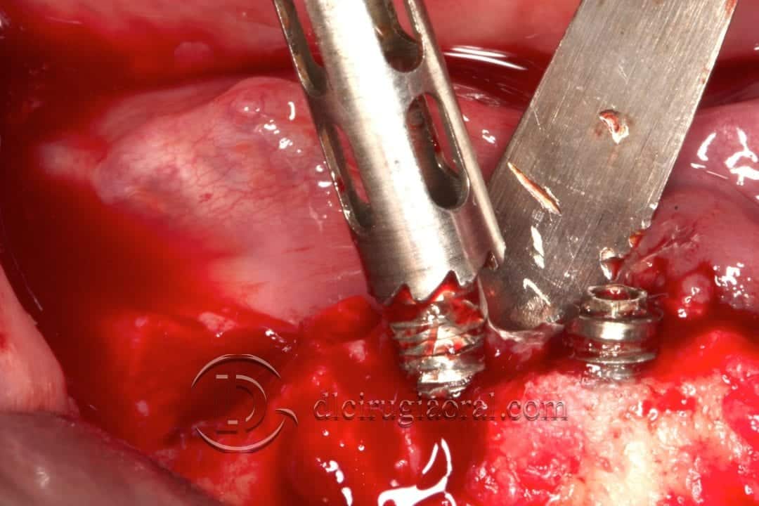 implantes dentales en sobredentadura inferior