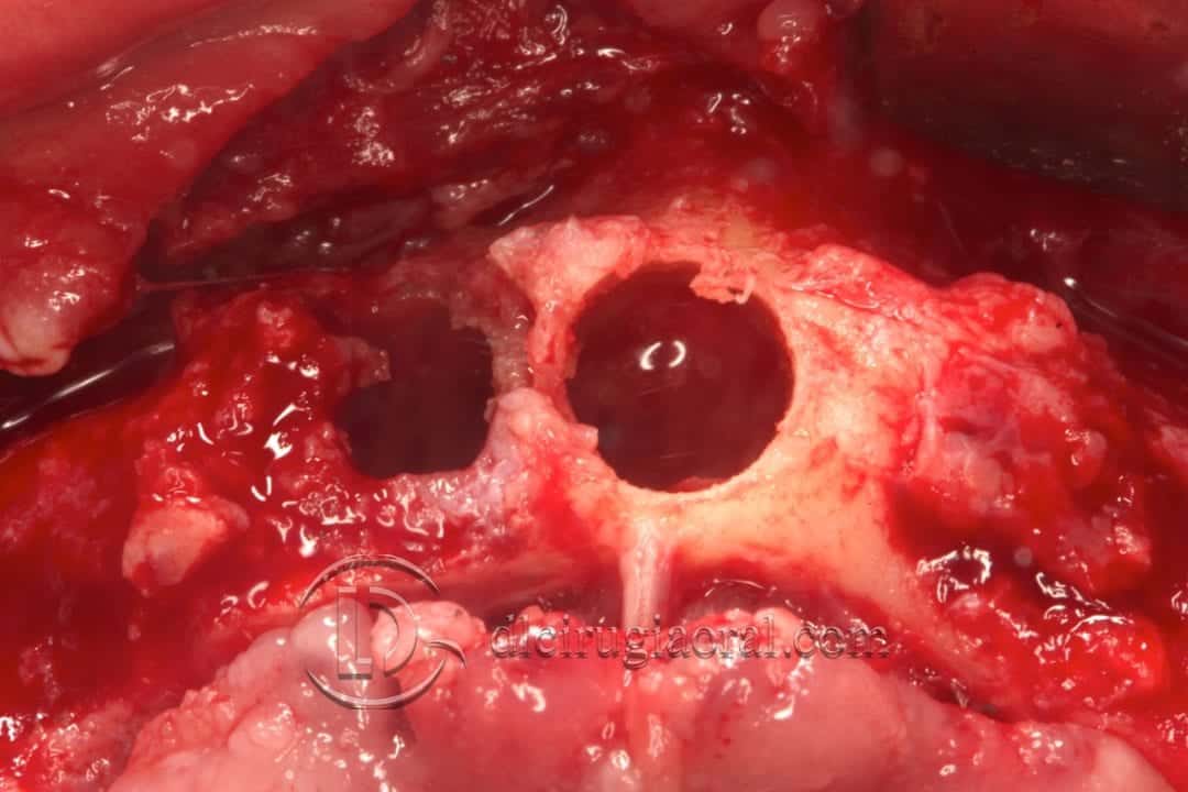 implantes dentales en sobredentadura inferior
