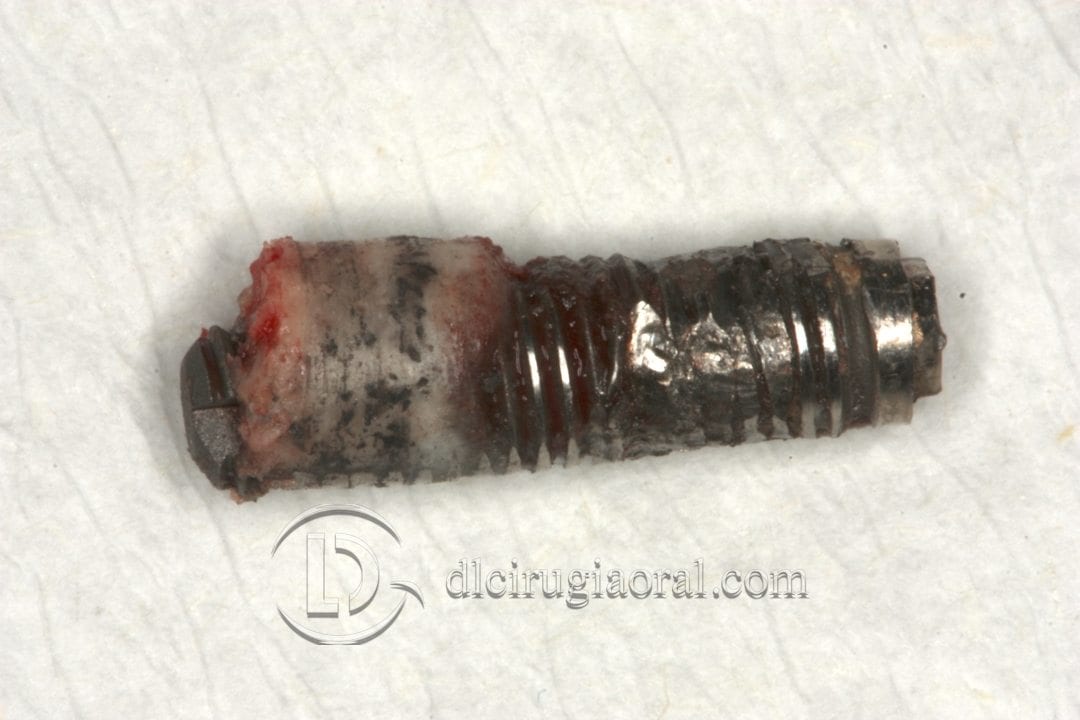 implantes dentales en sobredentadura inferior