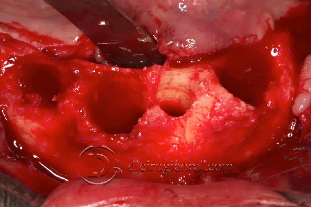 implantes dentales en sobredentadura inferior