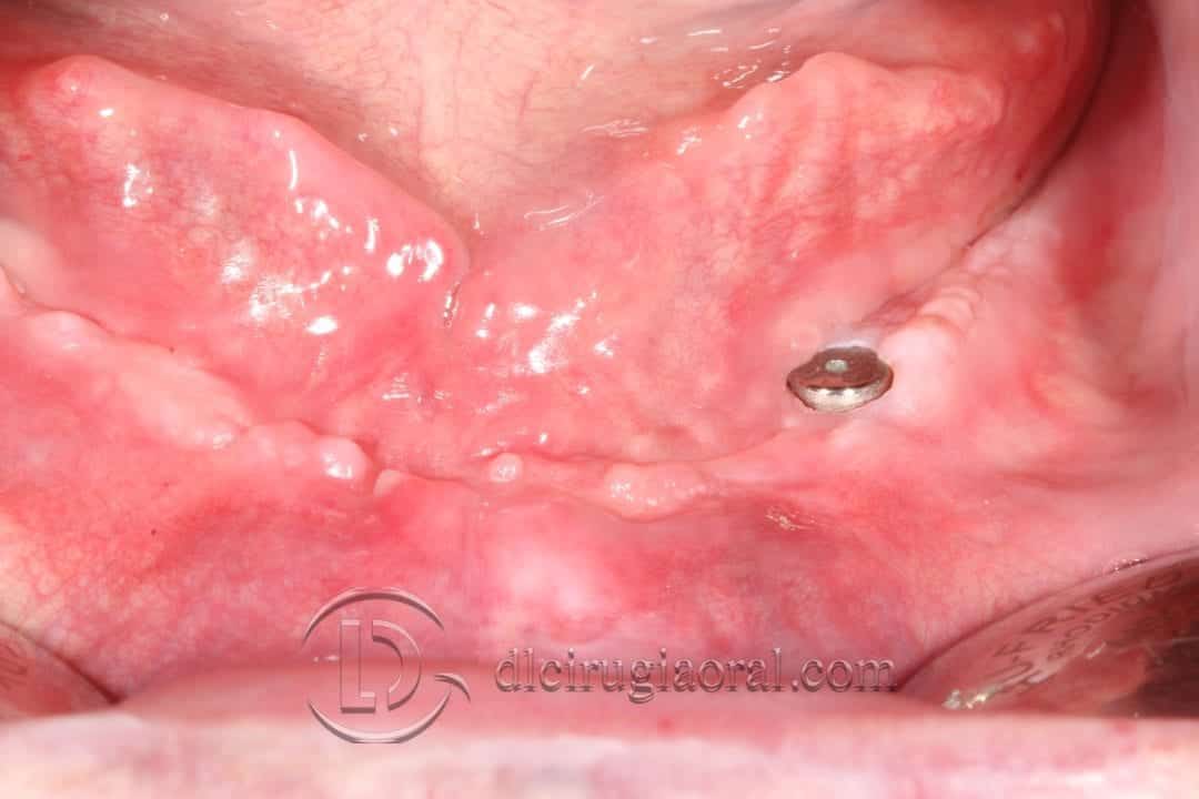 sobredentadura inferior
