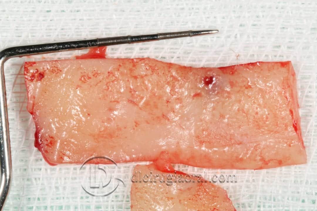 sobredentadura inferior