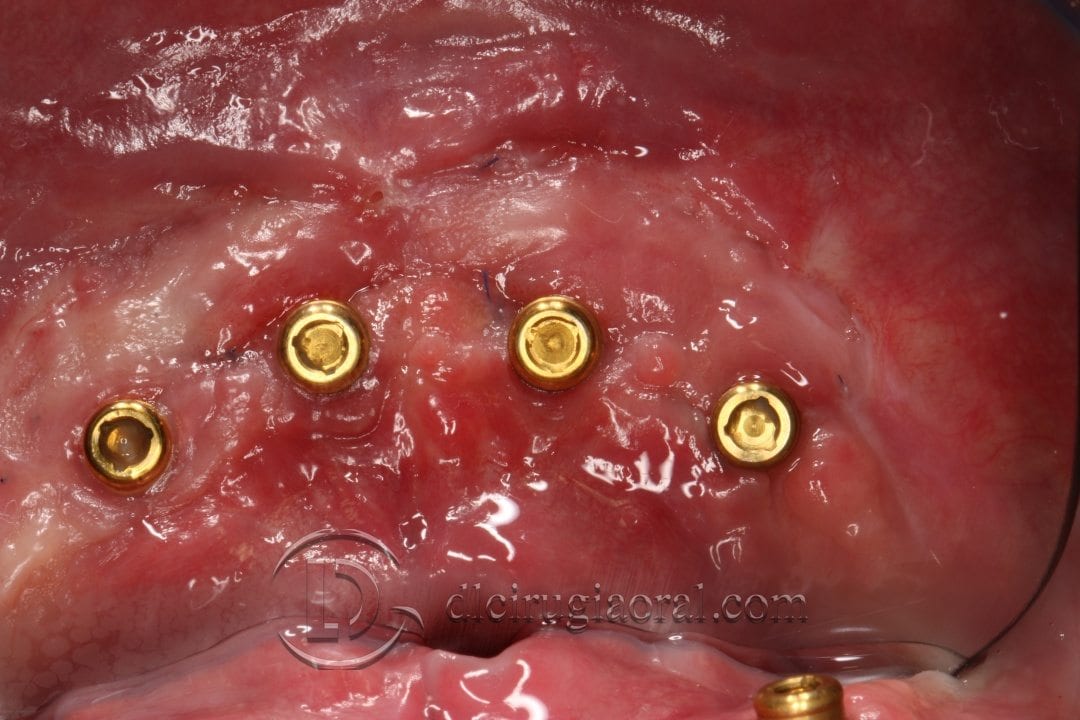 sobredentadura inferior