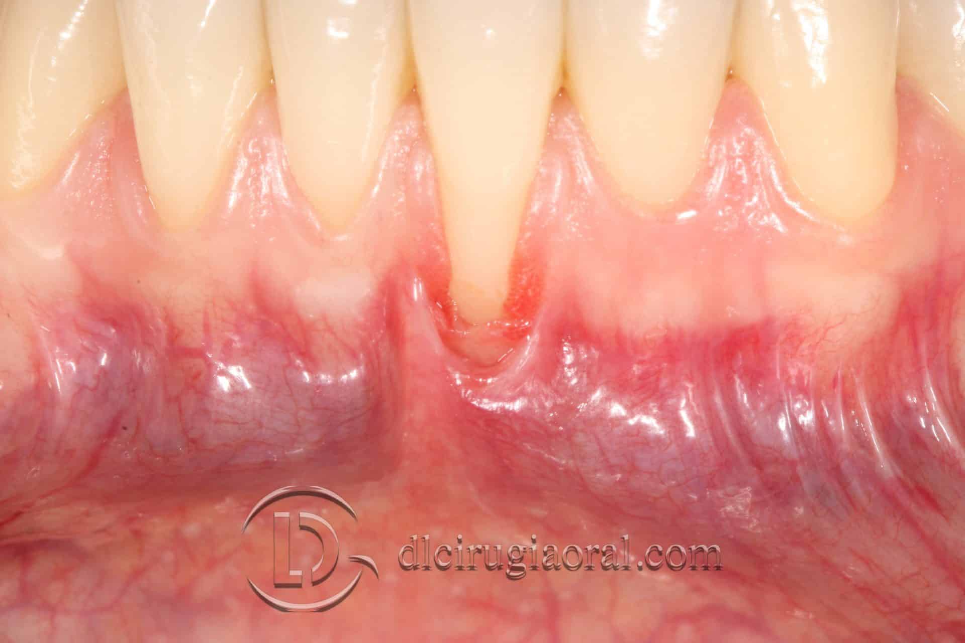 tratamiento recesión dental
