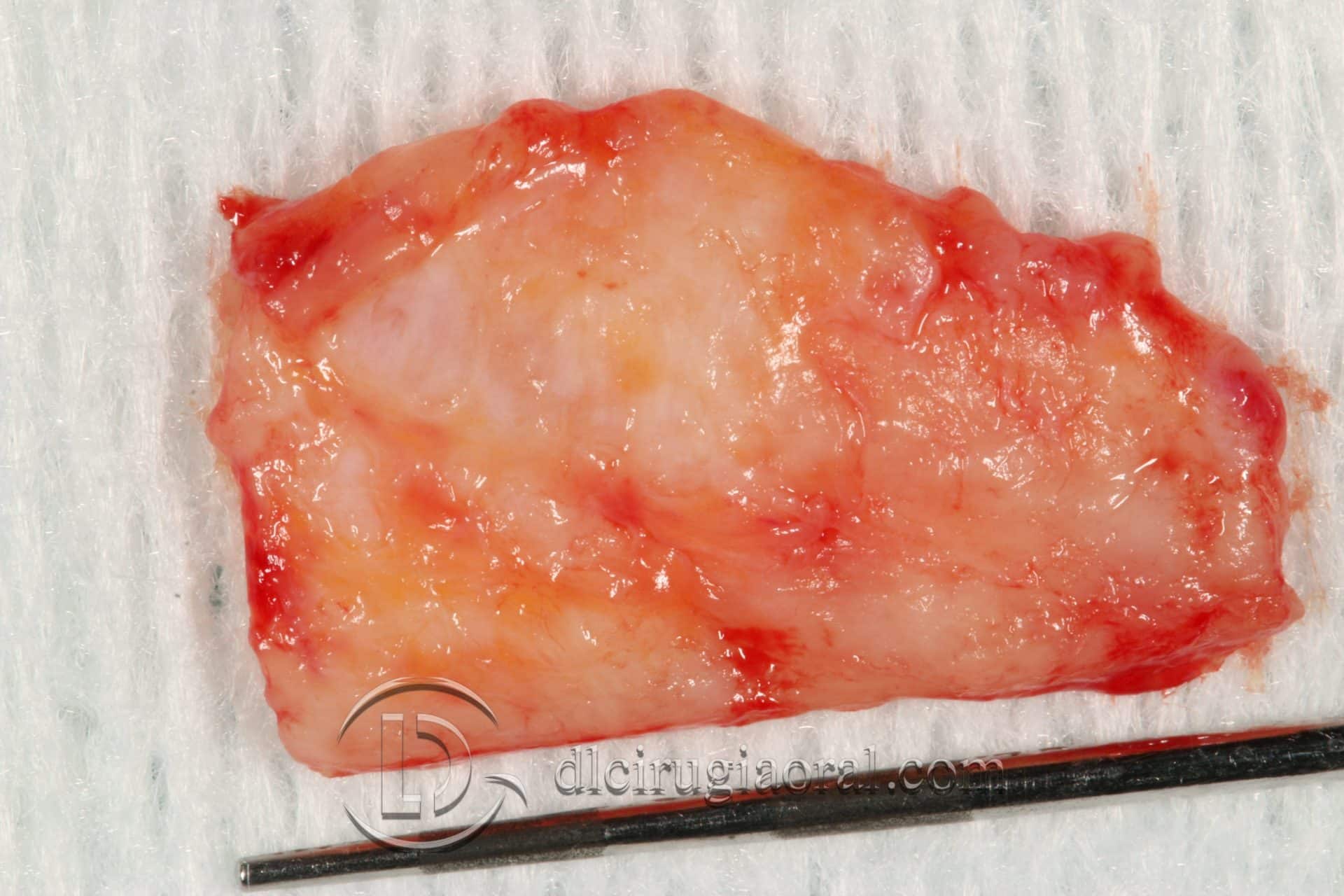 tratamiento recesión dental