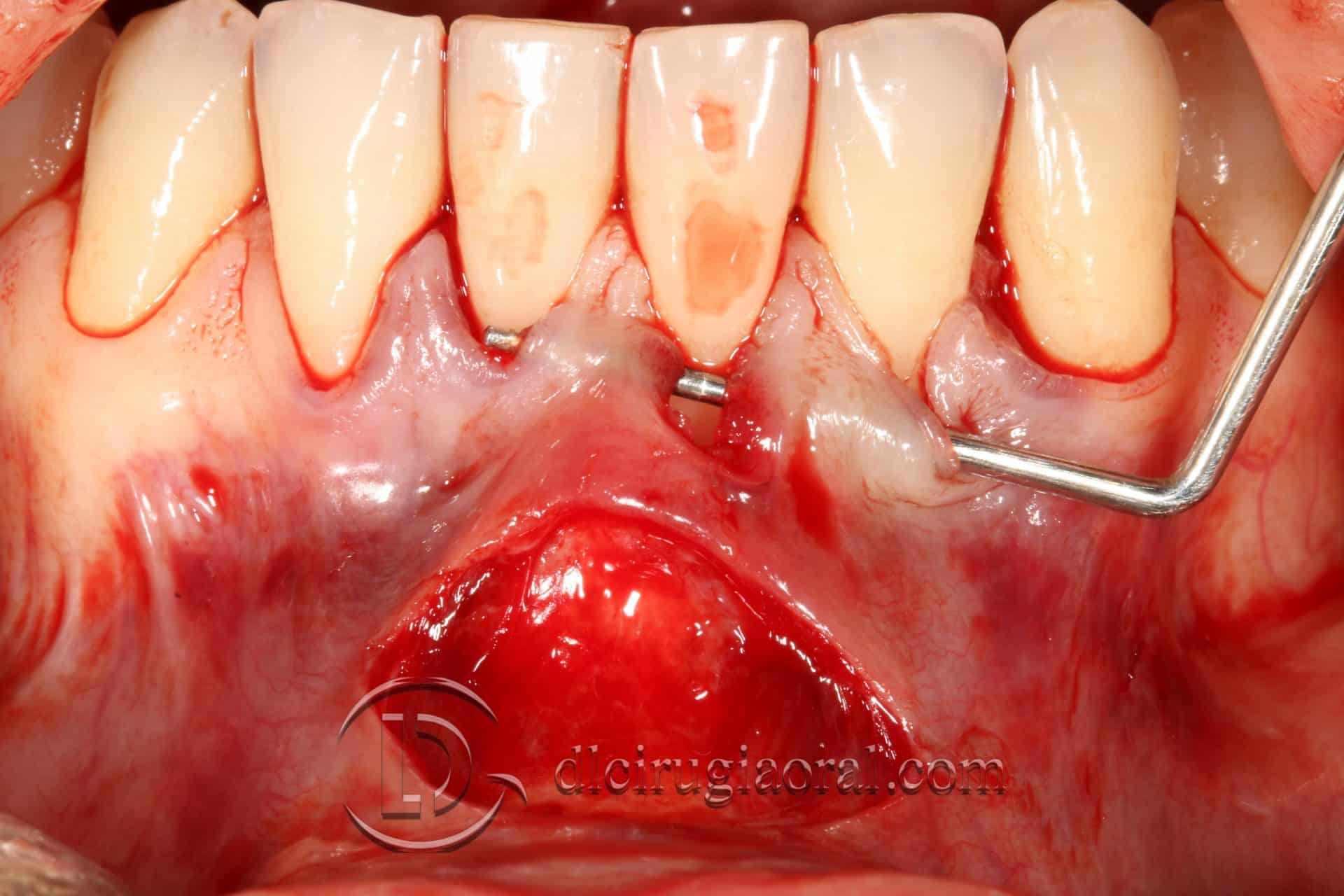 tratamiento recesión dental
