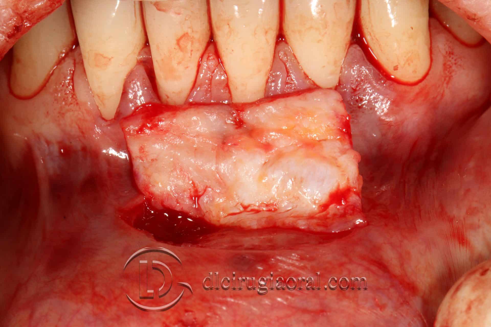 tratamiento recesión dental