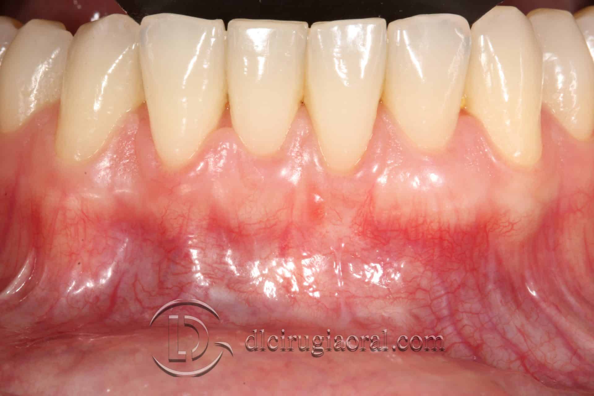 tratamiento recesión dental