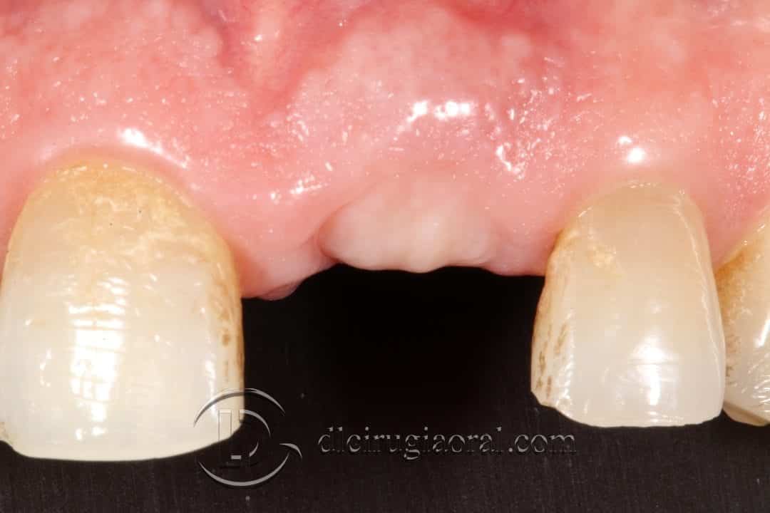 Socket Preservation