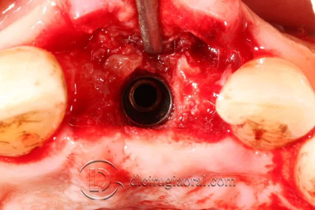 Socket Preservation