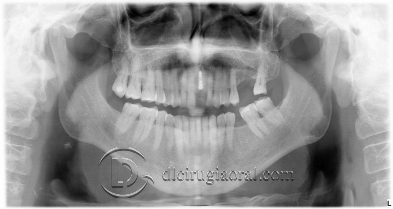 Socket Preservation