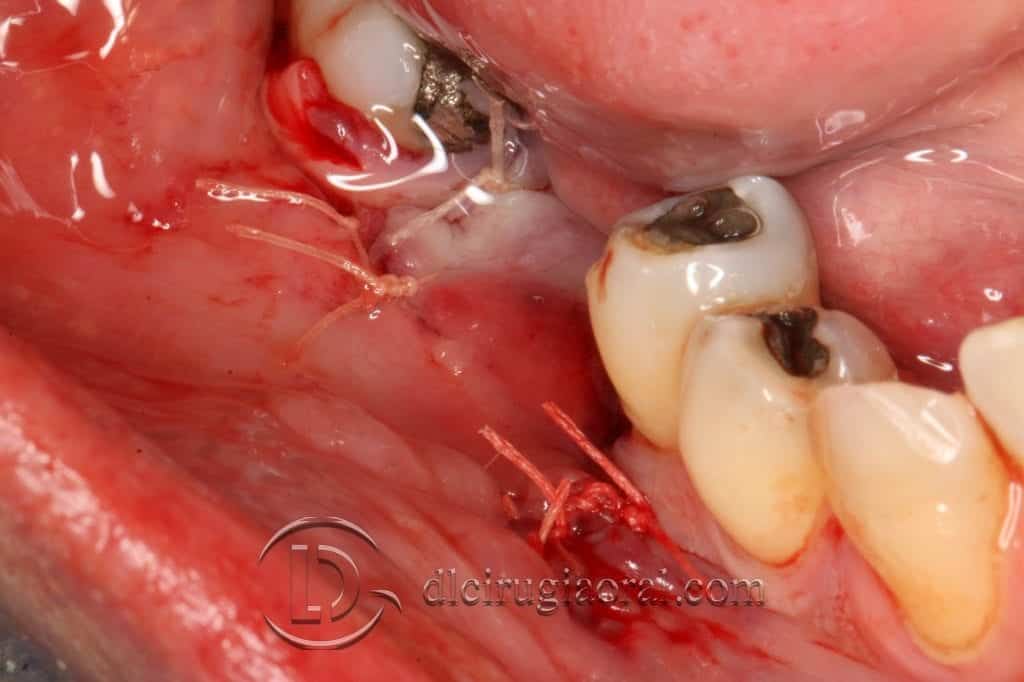 reconstrucción de defecto vertical en mandíbula