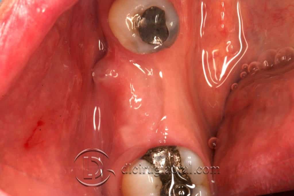 reconstrucción de defecto vertical en mandíbula