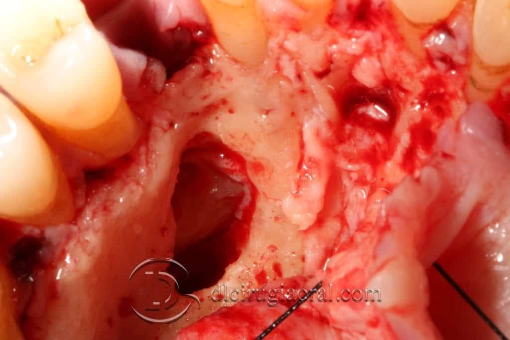 Manejo del canino incluido en implantología oral