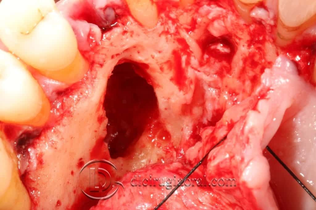 Manejo del canino incluido en implantología oral