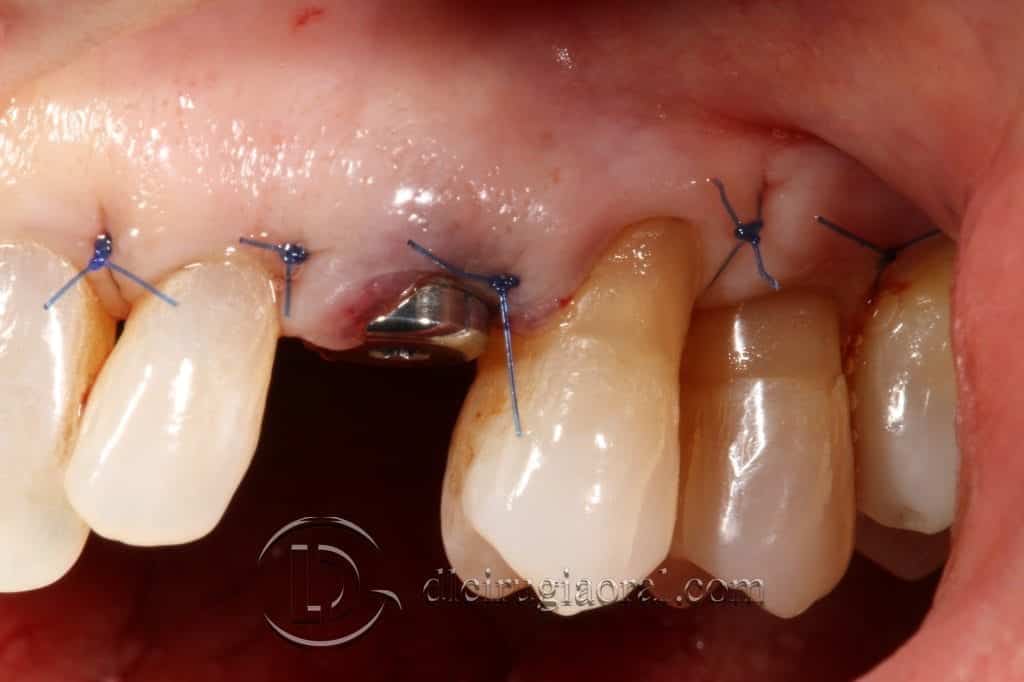 Manejo del canino incluido en implantología oral