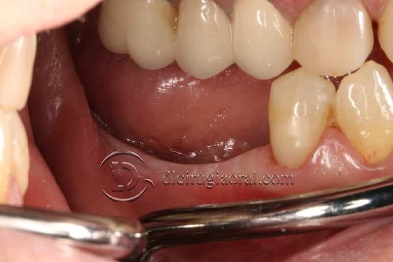 Aumento óseo vertical con Técnica de Khoury