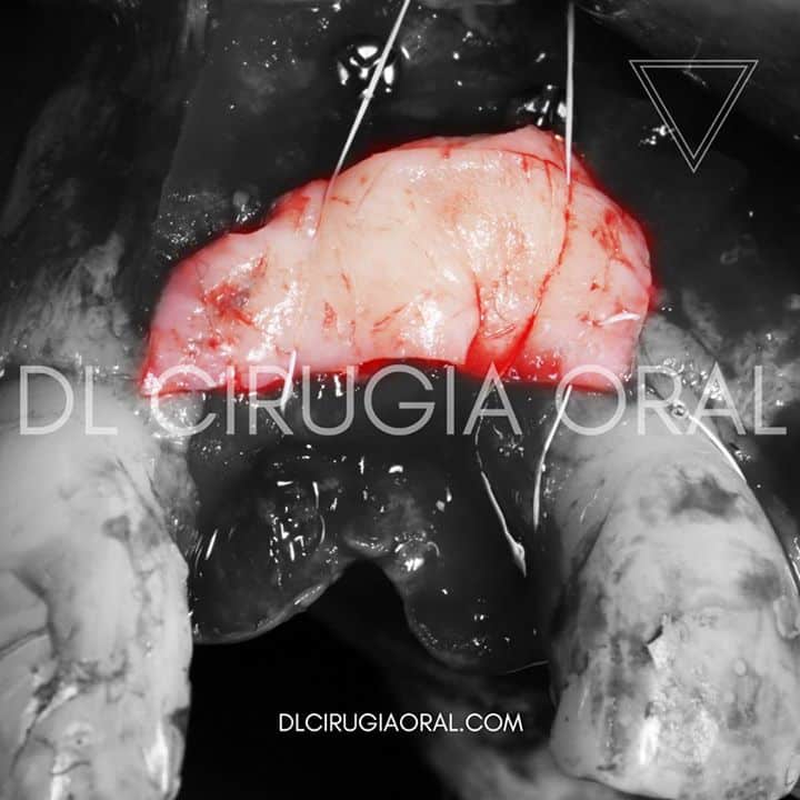 Injerto de tejido conectivo para dar volumen
