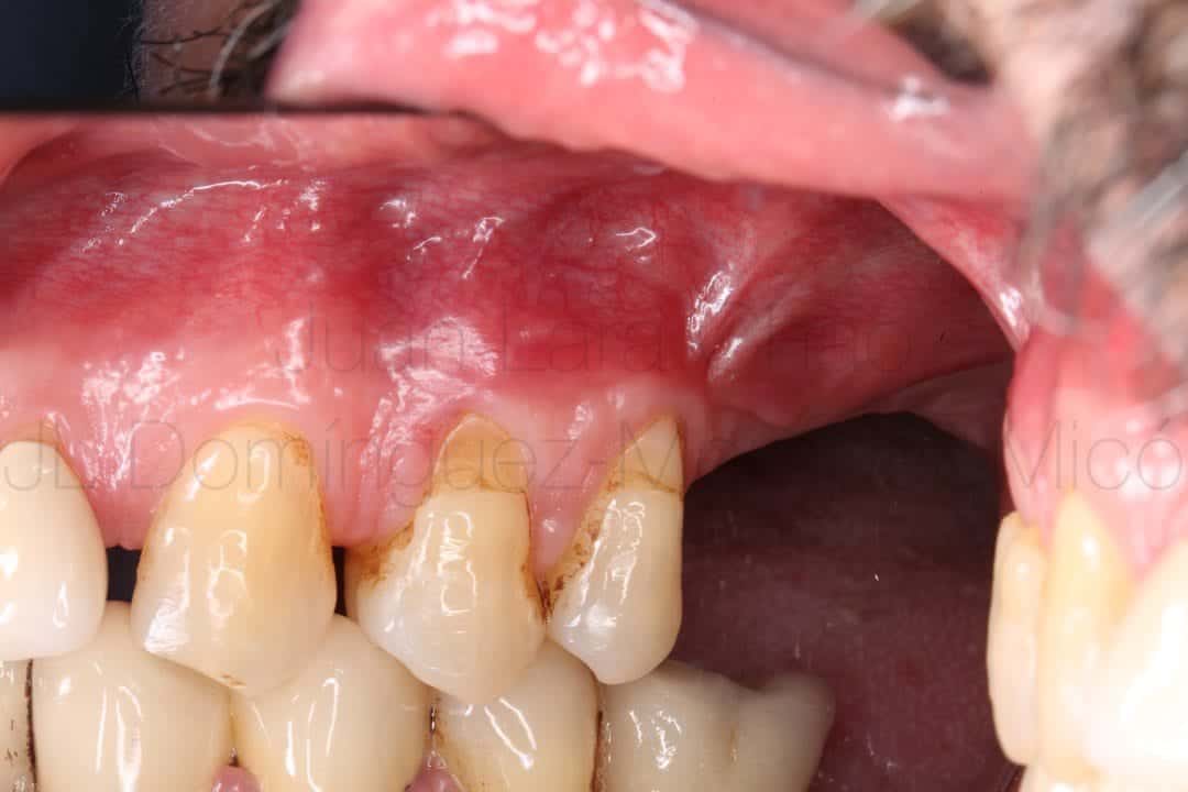 reconstrucción ósea maxilar