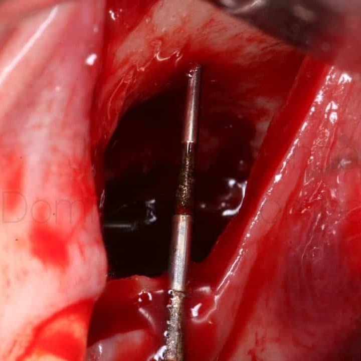 Procedimiento quirúrgico de acceso óseo para implantología dental