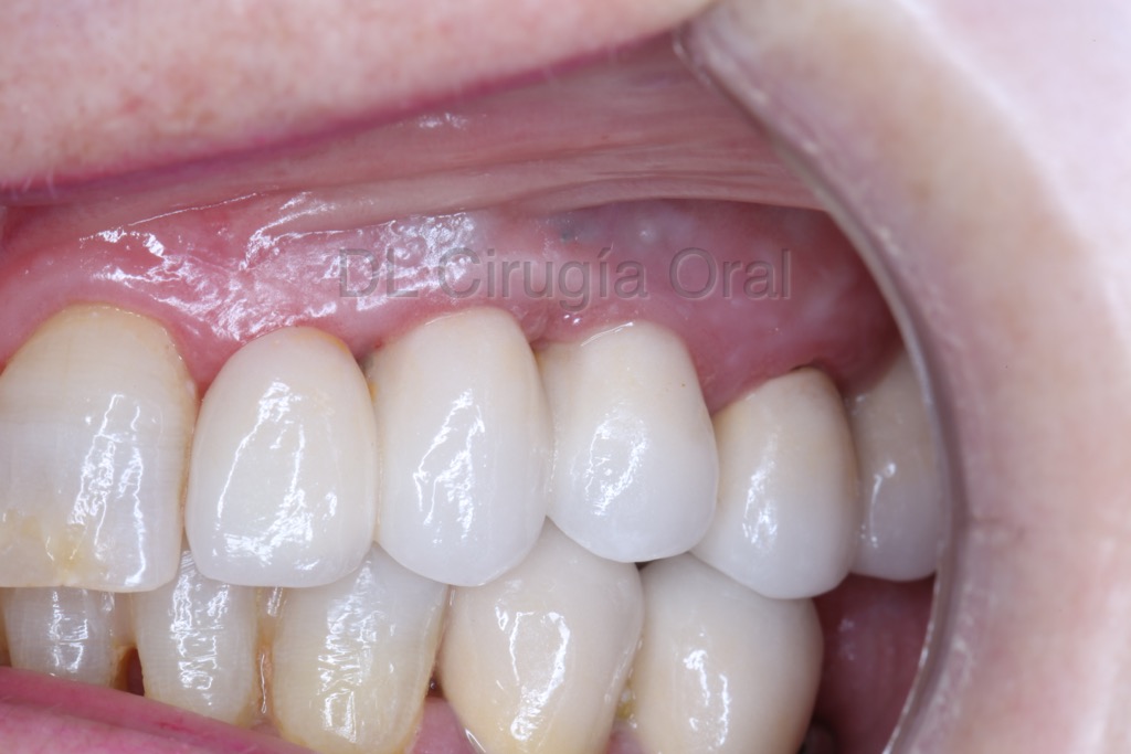 Falta de hueso y de dientes: colocación de implantes dentales con injerto de hueso