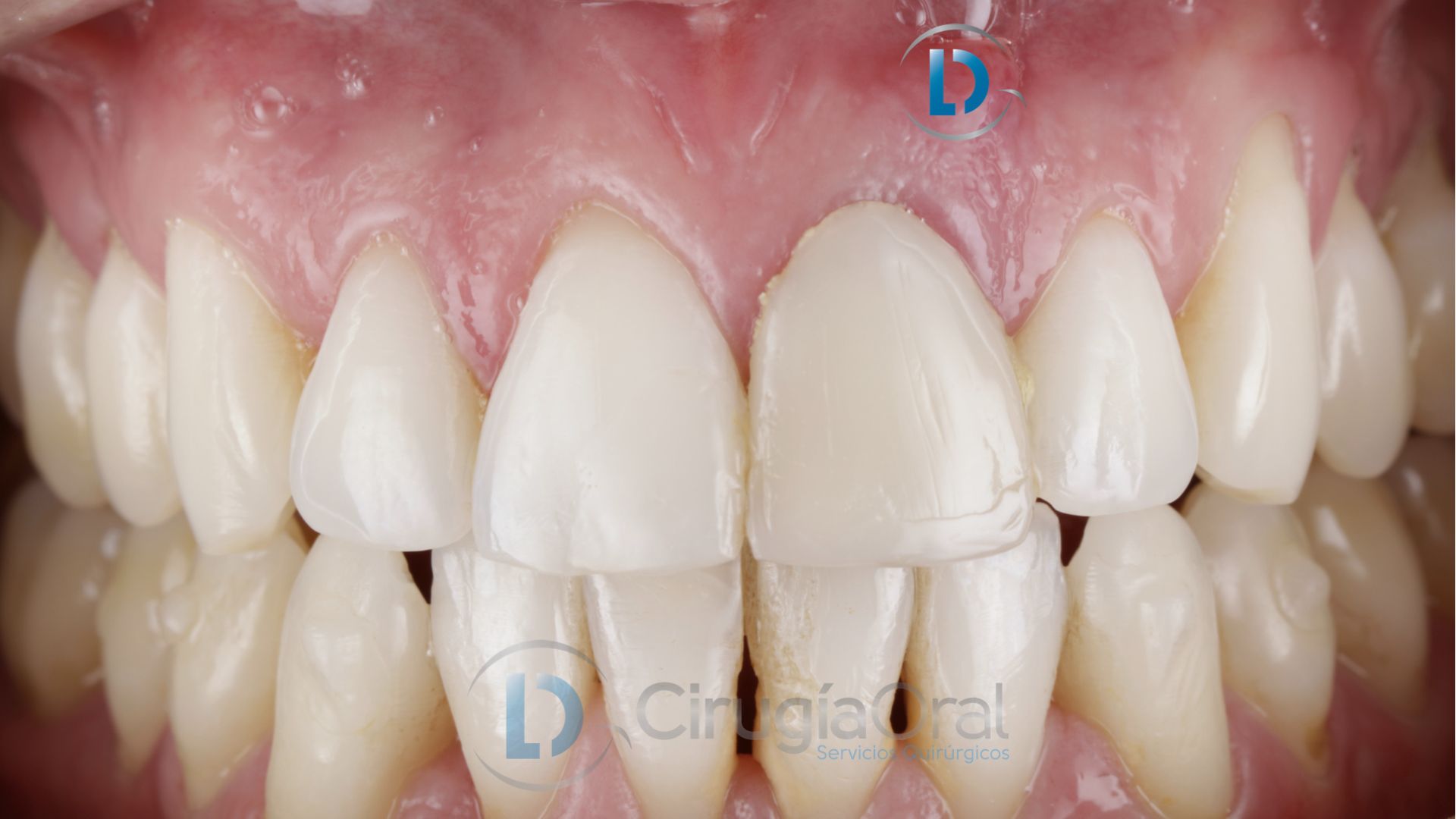 Implante dental en sector anterior
