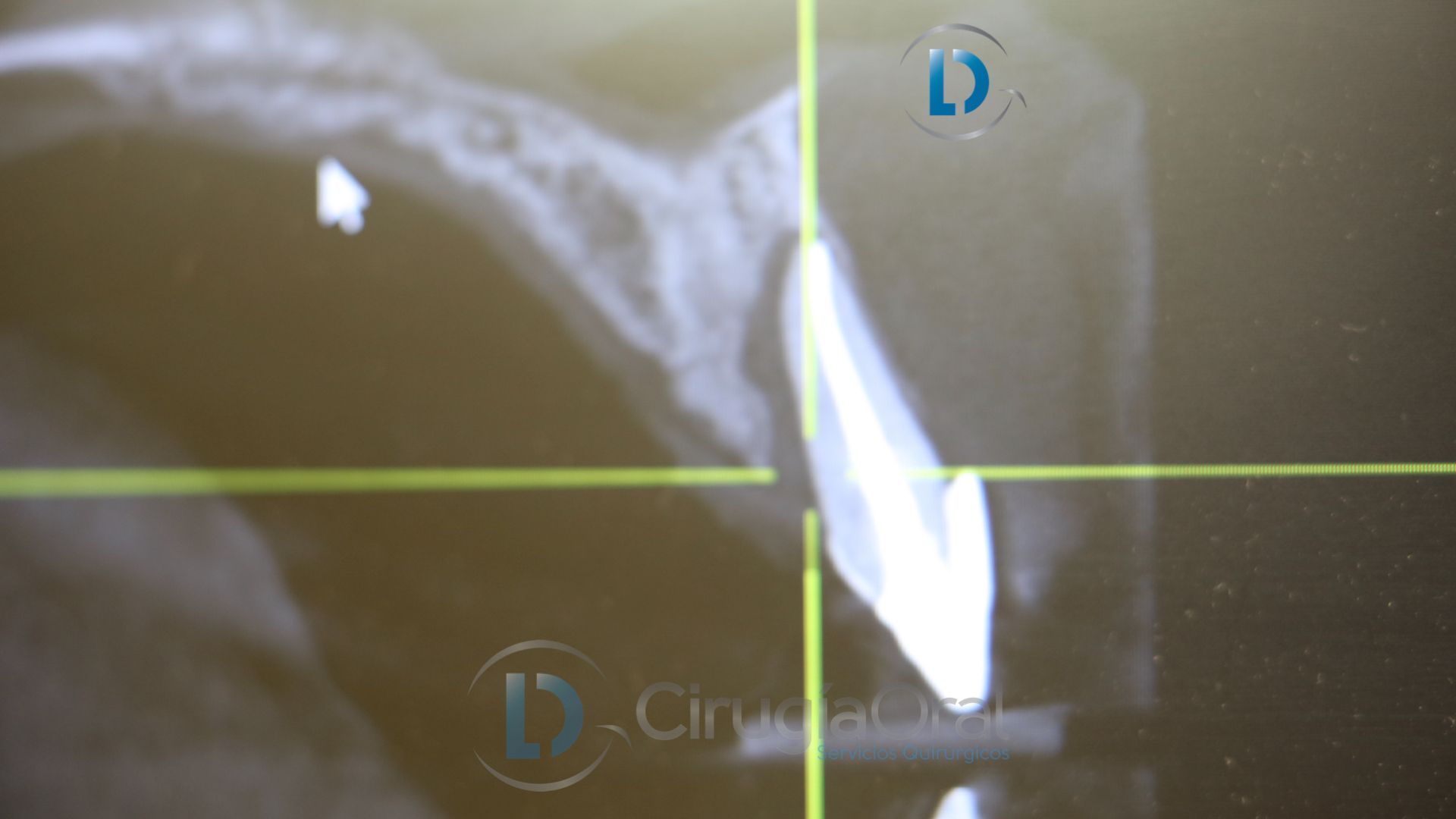 Implante dental en sector anterior
