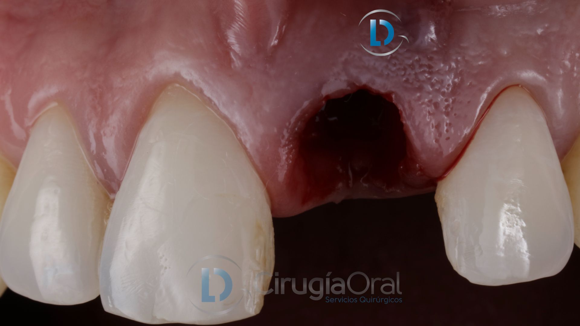 Implante dental en sector anterior