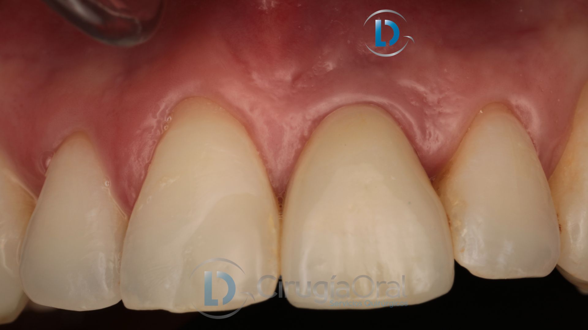 Implante dental en sector anterior