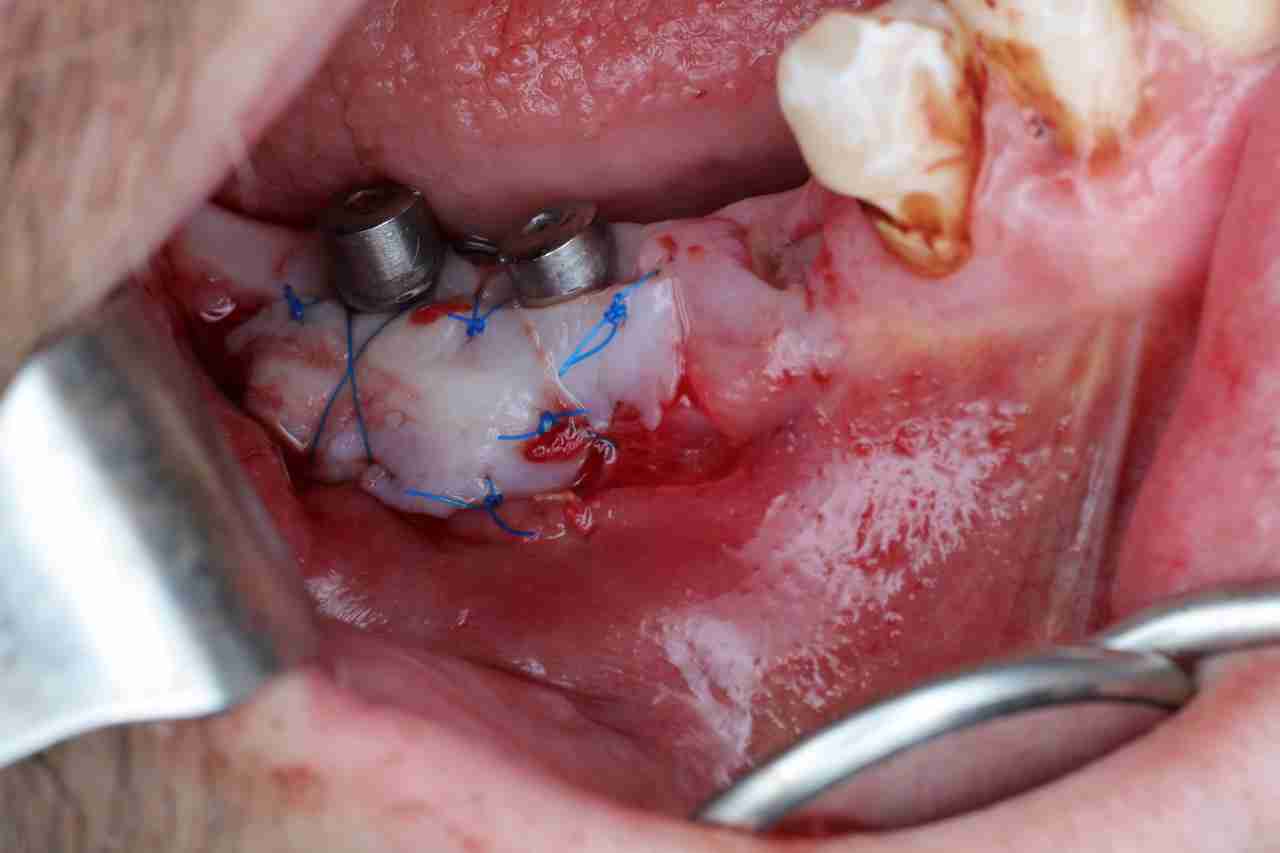 Curso de cirugía oral e implantología