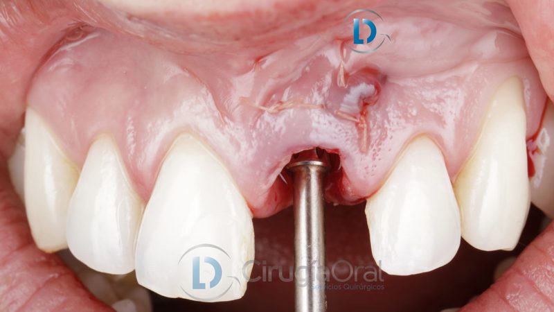 Implante dental en sector anterior: Injerto de hueso dental + encía  + carga inmediata