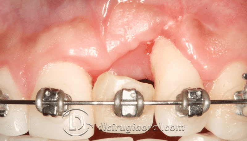Pérdida de implante dental: solución con injerto de hueso y de encía