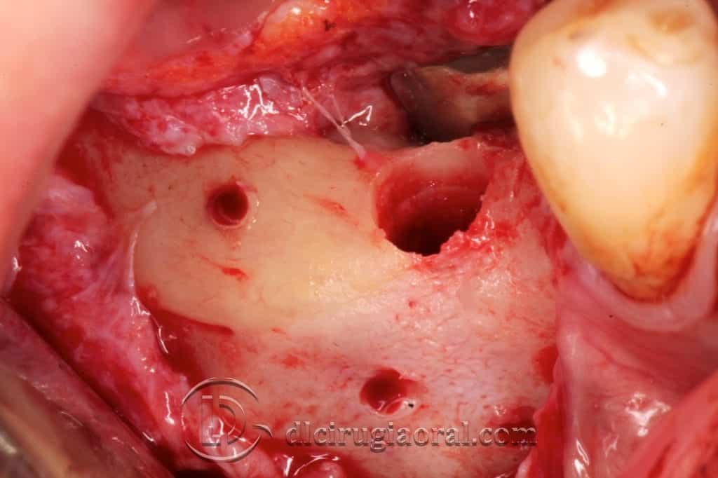 Ganancia de 9 mm de altura en mandíbula: Cirugía de implantes