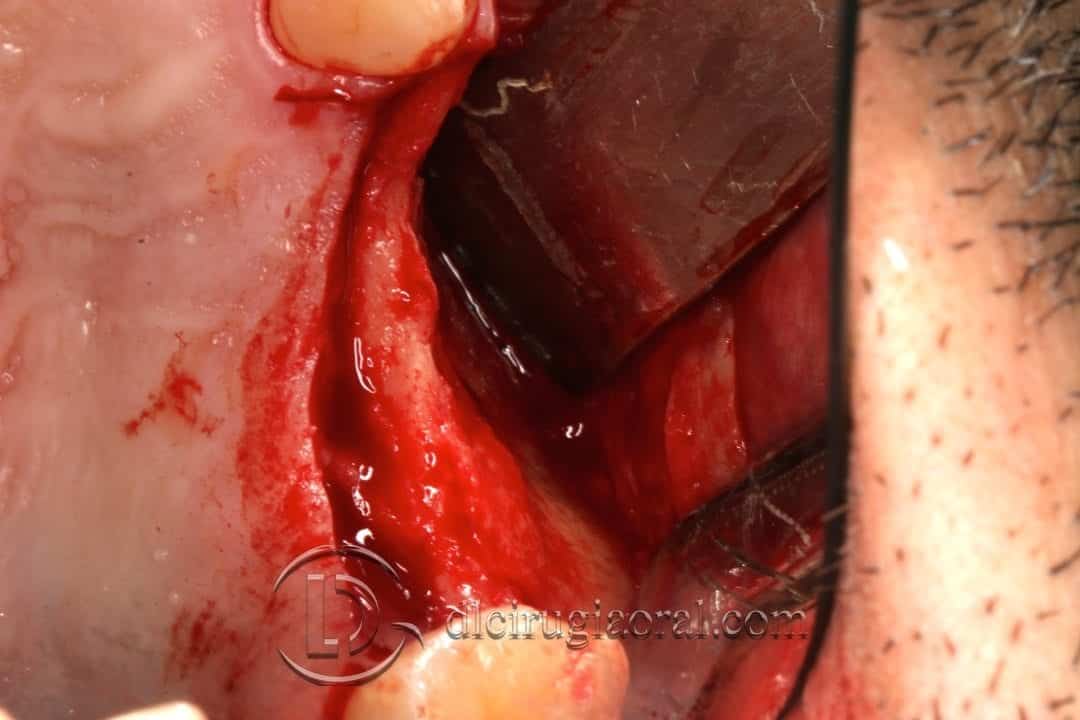 Ganancia horizontal maxilar y colocación de implantes