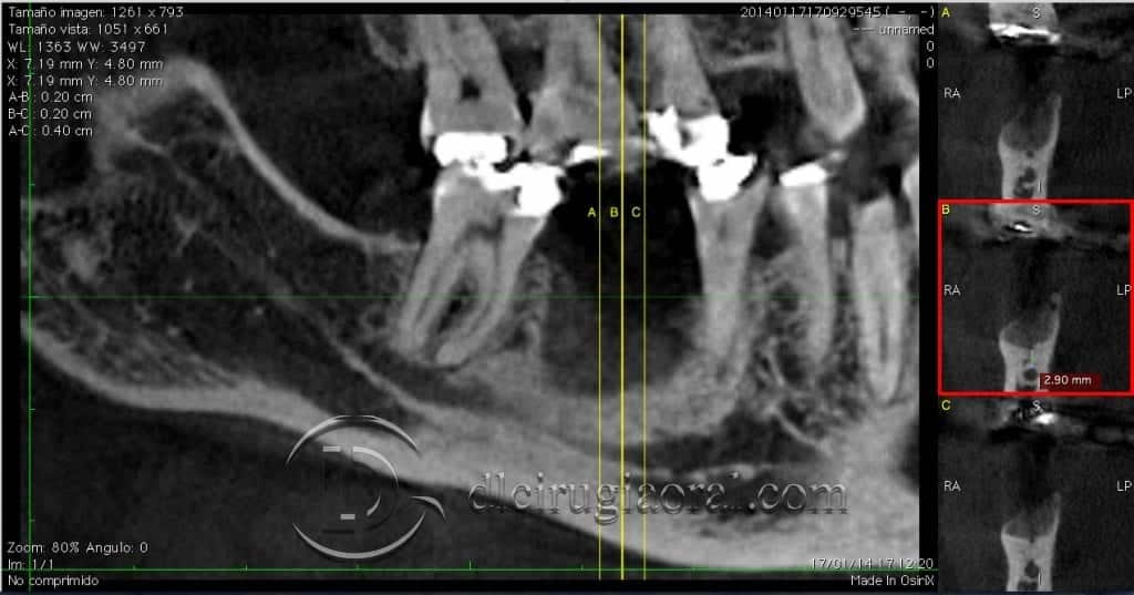 Reconstrucción de defecto vertical localizado en mandíbula