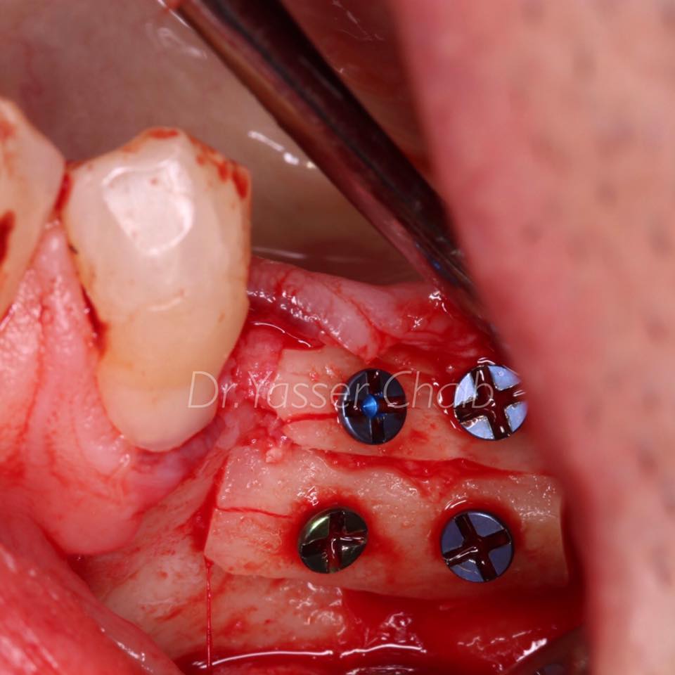 Reconstrucción mandibular en mandíbula posterior
