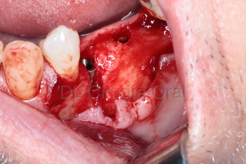 Implante dental con falta de hueso