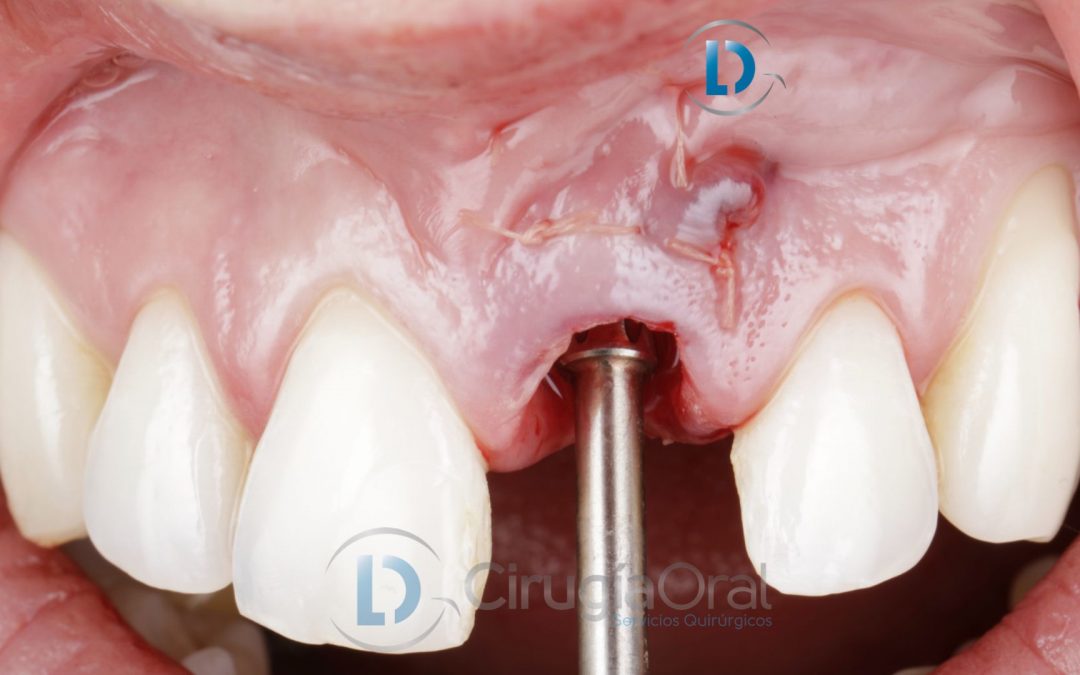 Implante dental en sector anterior: Injerto de hueso dental + encía  + carga inmediata